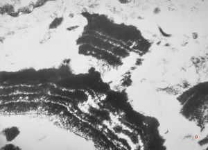 M,66y. | follicular cyst with hyaline Rushton bodies M,66y. | follicular cyst with hyaline Rushton bodies
